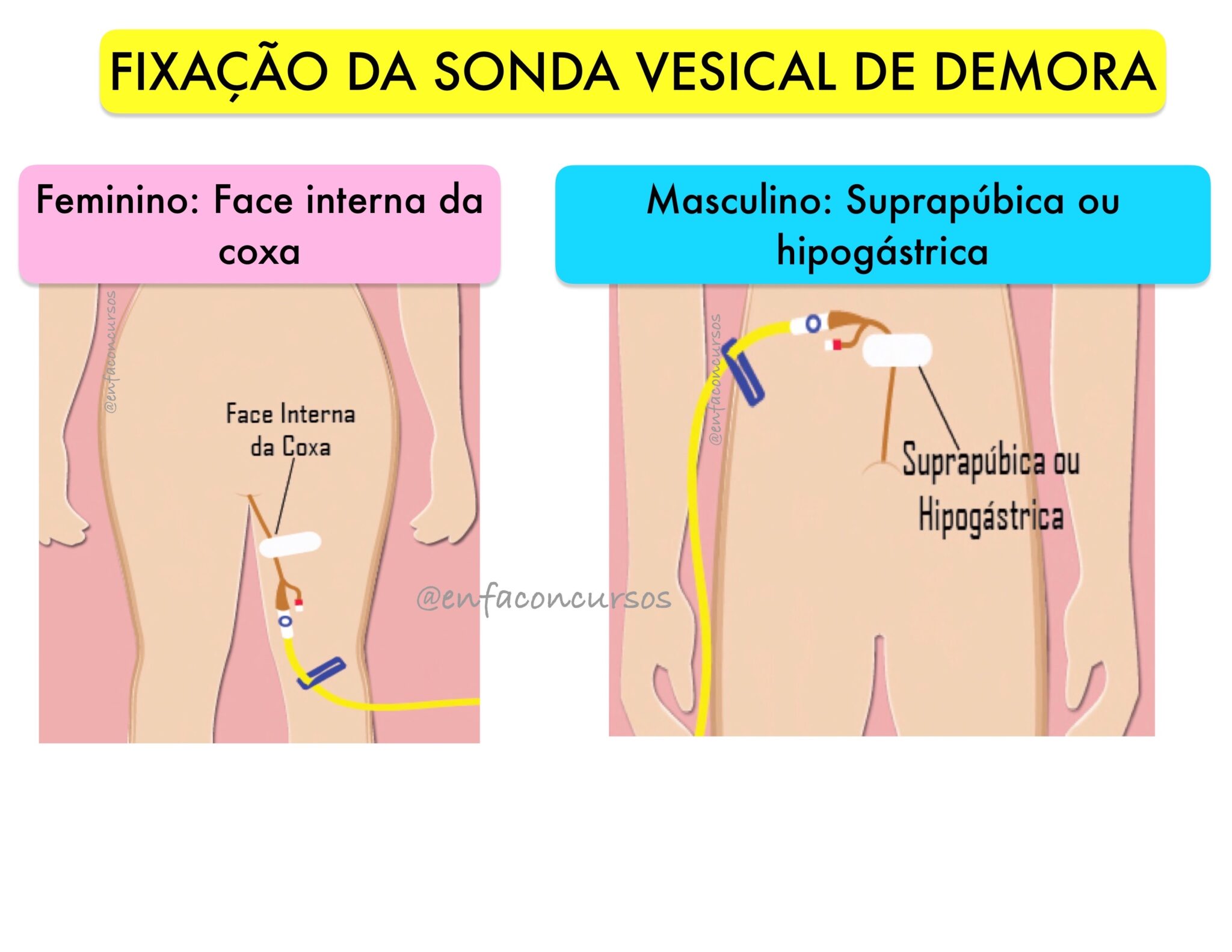 Fixa O Da Sonda Nasog Strica M Todos Import Ncia